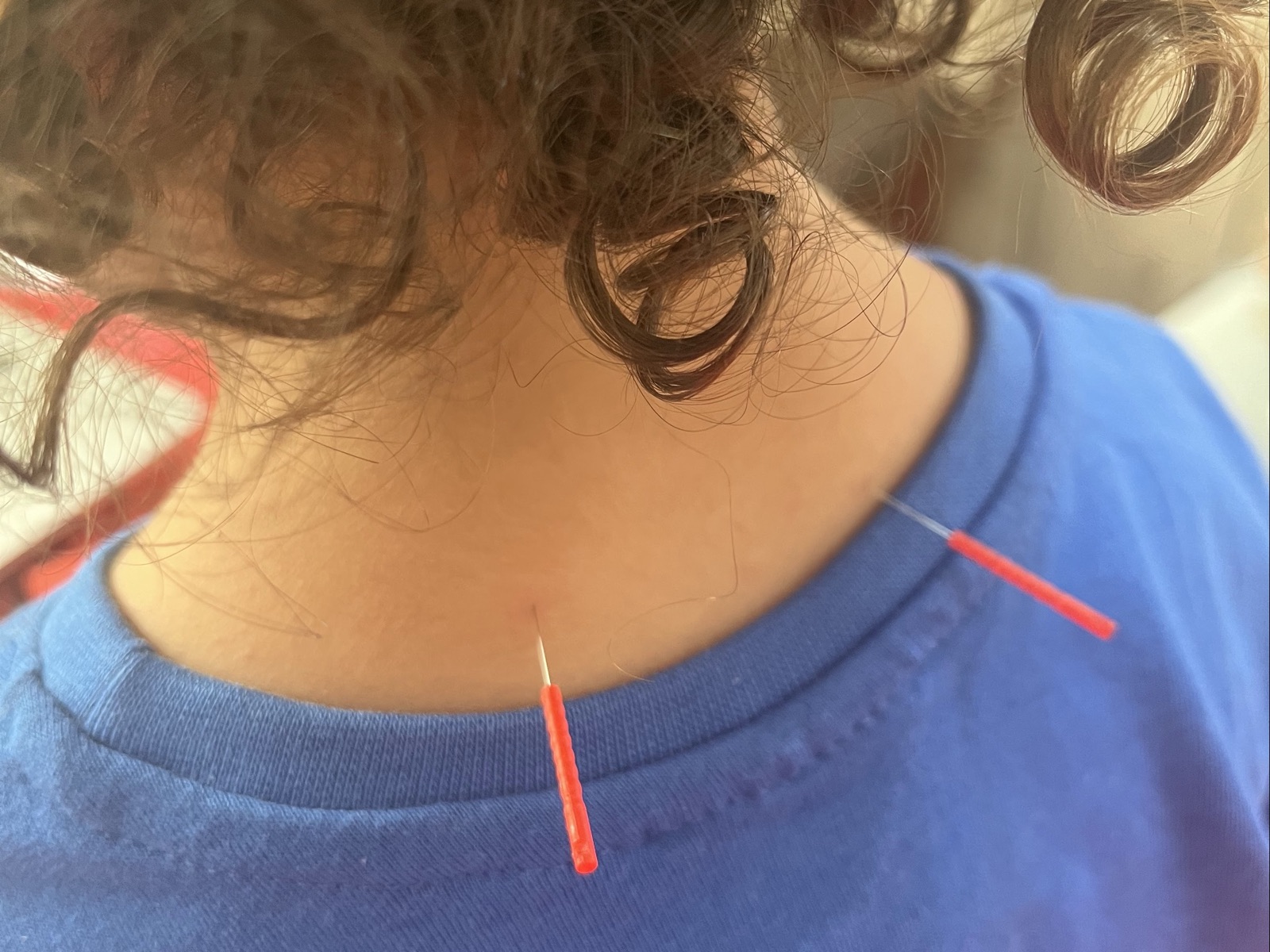 ילד בחולצה כחולה עם שתי מחטי דיקור זעירות בעורף, בזמן טיפול רגוע